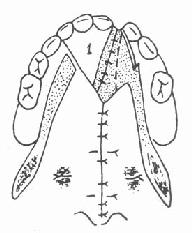 ��ϱ�ǻ��ճĤ