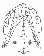 ��ת���޲�