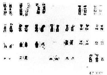 Klinefelter�ۺ����ĺ���47,XXY