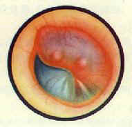 ���Ի�ŧ���ж��׹�Ĥ��Ѫ��¡